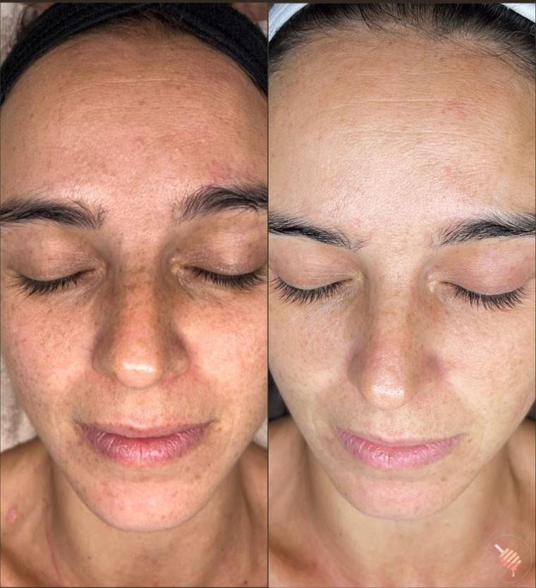 Before and after: a client's skin looks brighter and more natural after 10 months of Lift + Renew treatments